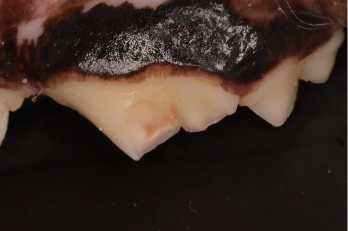 コンポジットレジン修復 Before