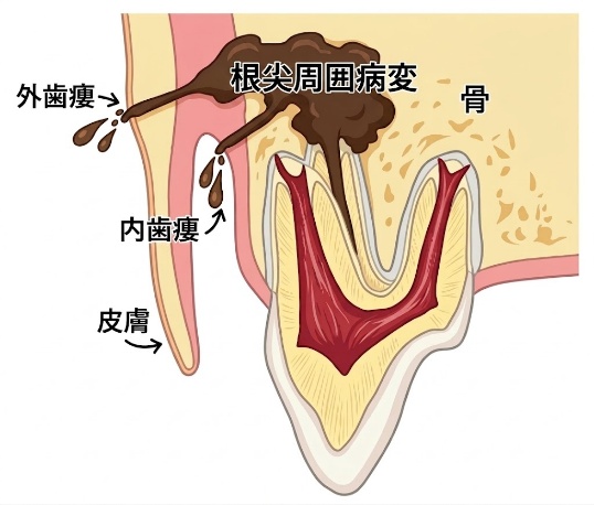 外歯瘻の仕組み