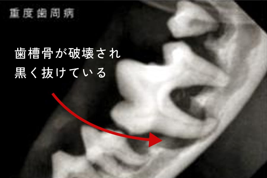 重度歯周病
