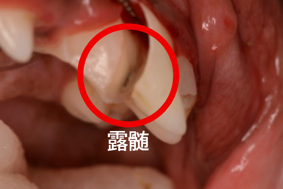 根管治療 症例2
