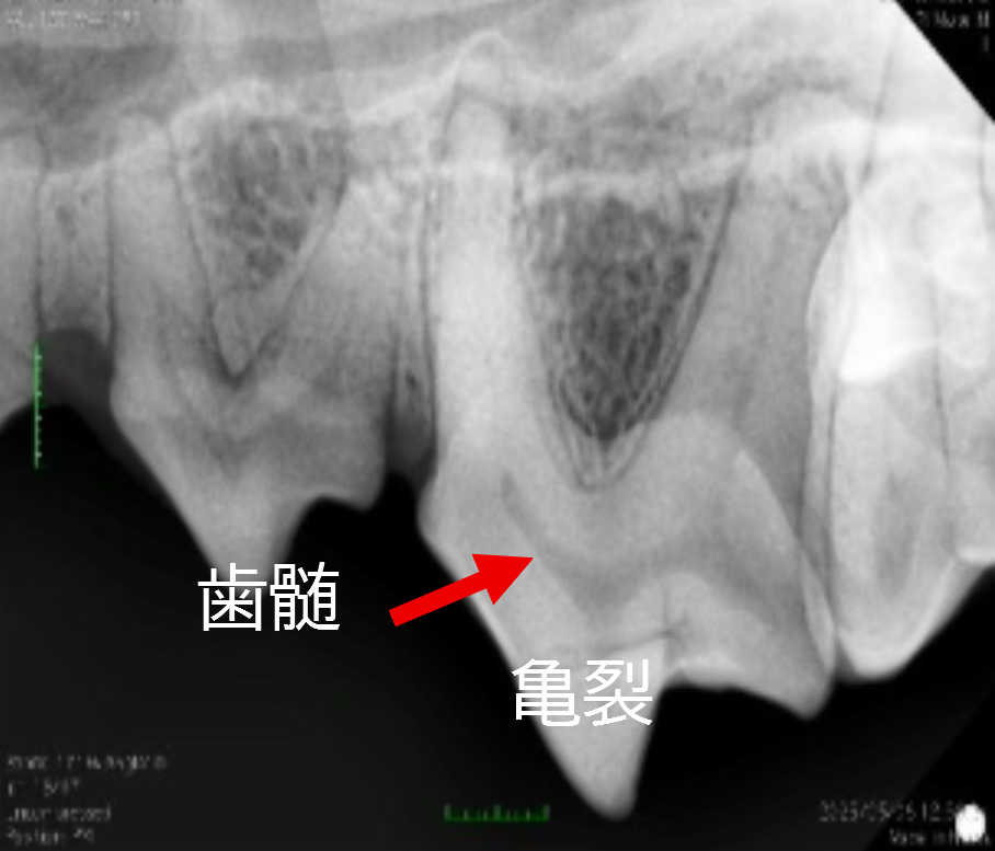 根管治療 レントゲン