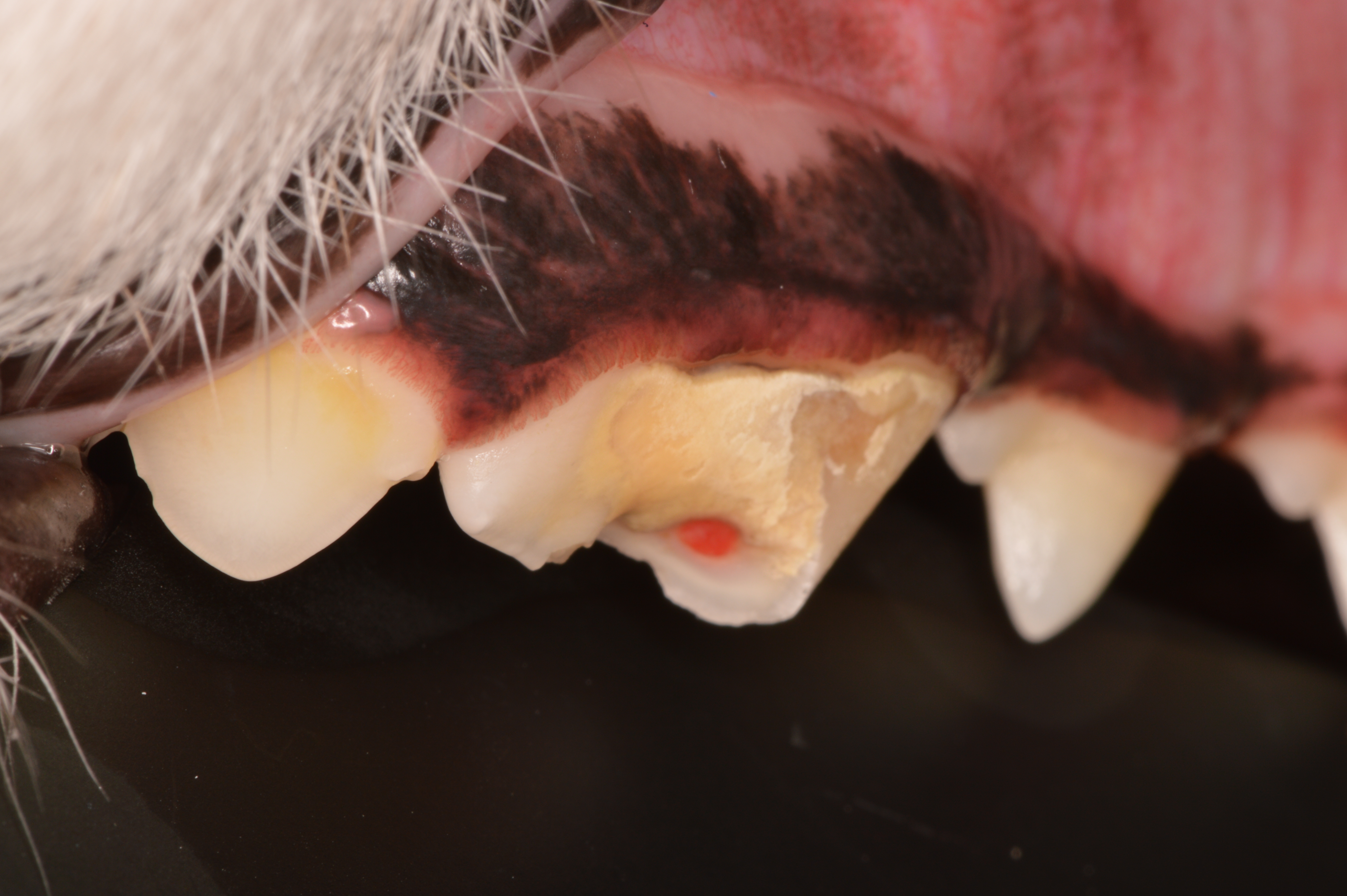 割れた歯をあきらめないで！抜髄根管治療で守る大切な歯