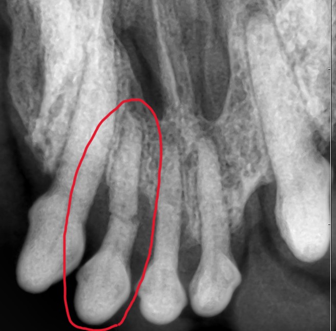 【歯科症例】上顎の前歯が折れてしまい、抜歯を行ったわんちゃん